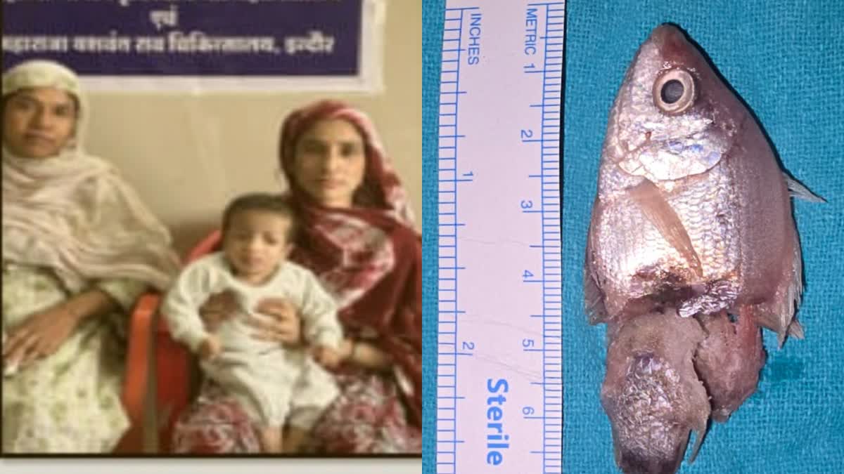 बच्चे के गले में फंसी जिंदा मछली, खेल-खेल में मुंह में रखी थी, डॉक्टरों ने बचाई जान