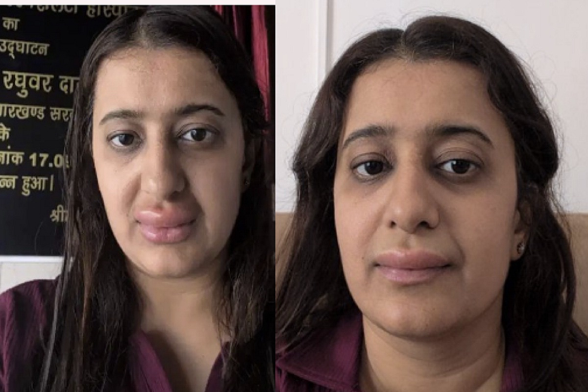 मां-बेटे ने खाया वंदे भारत एक्सप्रेस का खाना, महिला के सूजे होंठ; बेटे की स्थिति हुई गंभीर